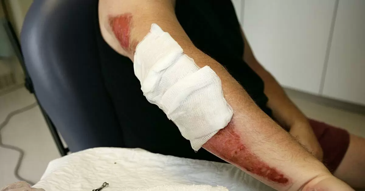 ​What Are the Most Common Types of Motorcycle Accident Injuries?